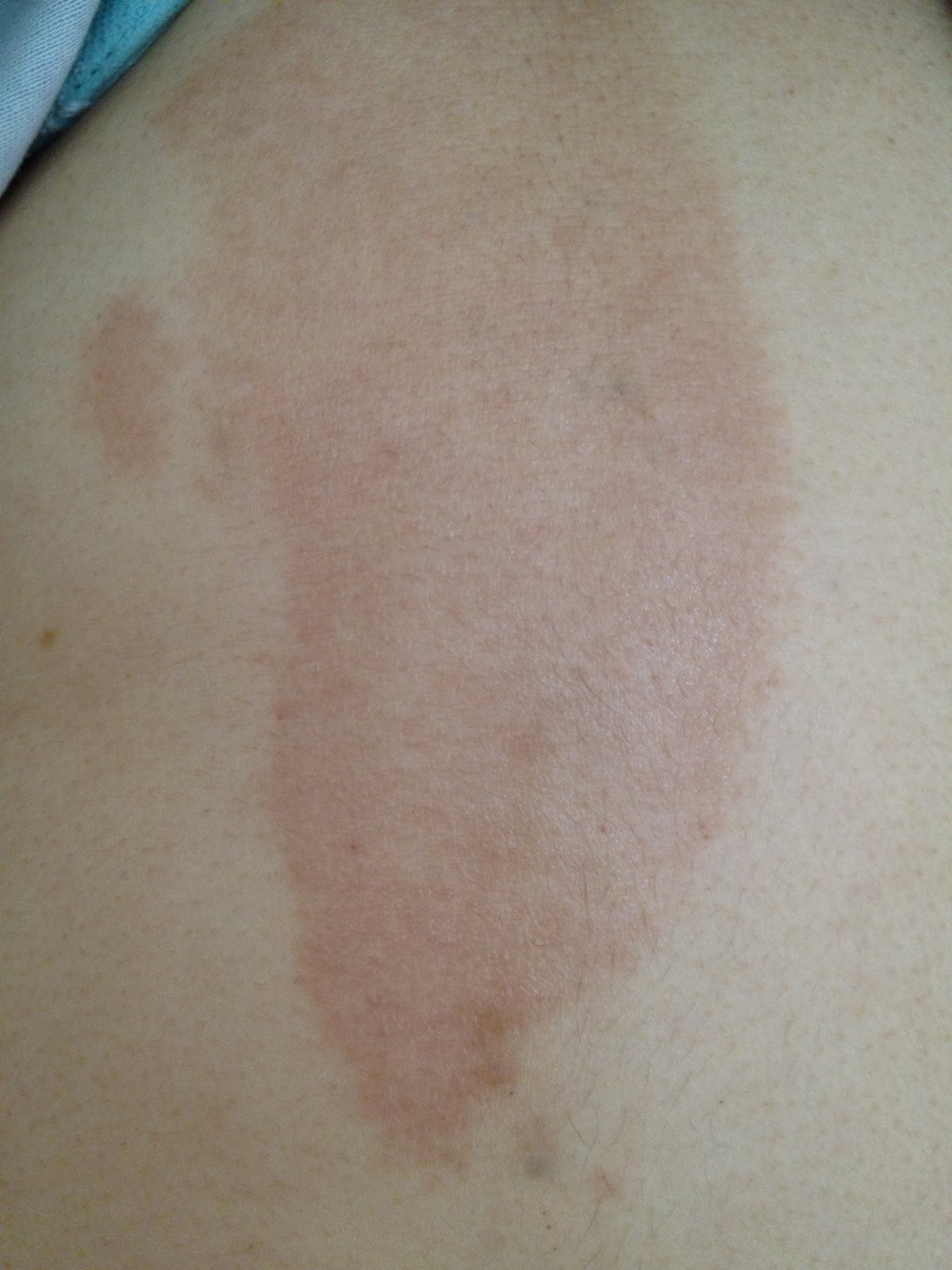 Palmer's cocoa butter. See it used on me! Do not read post if sensitive